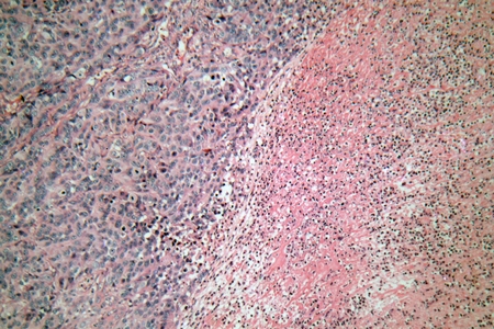 悪性黒色腫 皮膚癌 細胞を顕微鏡で人間の皮膚の細胞 の写真素材 画像素材 Image 6192