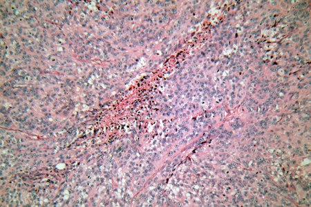 悪性黒色腫 皮膚癌 細胞を顕微鏡で人間の皮膚の細胞 の写真素材 画像素材 Image 6192